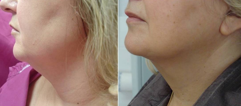 Neck liposuction